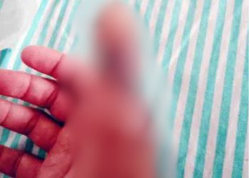 Paciente espera há quatro meses por cirurgia de dedo em Porto Velho