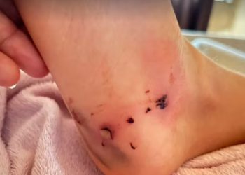 Criança é atacada por pitbull em Porto Velho; pai relata desespero durante o incidente