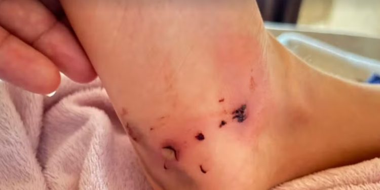 Criança é atacada por pitbull em Porto Velho; pai relata desespero durante o incidente