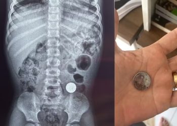 Criança de 3 anos engole bateria de lítio e recebe atendimento médico em Ji-Paraná