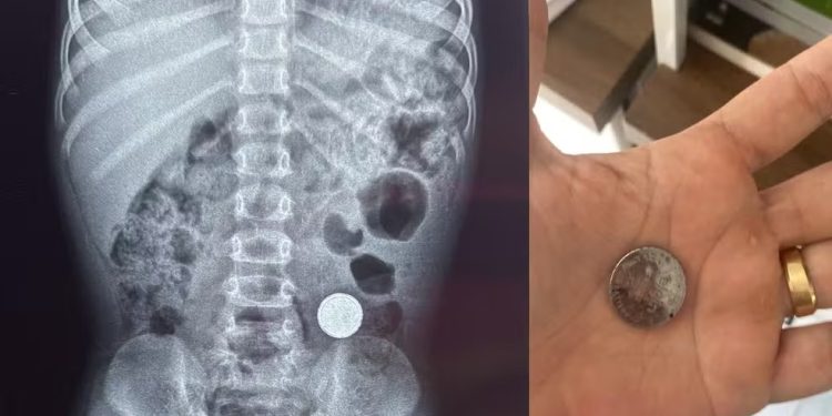 Criança de 3 anos engole bateria de lítio e recebe atendimento médico em Ji-Paraná