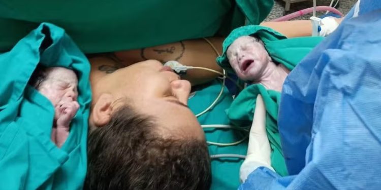 Jovem de Jaru dá à luz trigêmeas idênticas após gravidez considerada rara em Rondônia