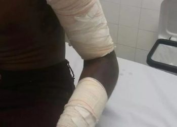 Discussão termina em tragédia: homem joga óleo quente no rosto da esposa em Ji-Paraná