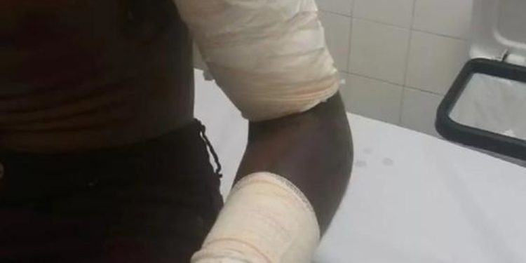 Discussão termina em tragédia: homem joga óleo quente no rosto da esposa em Ji-Paraná