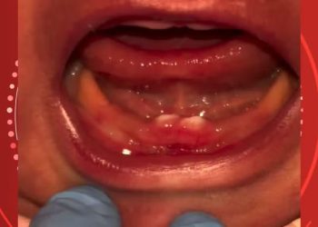 Bebê nasce com dentes em RO e passa por cirurgia nos primeiros dias de vida