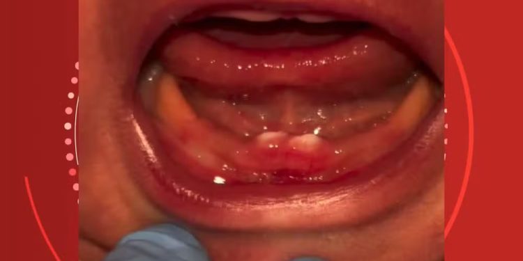 Bebê nasce com dentes em RO e passa por cirurgia nos primeiros dias de vida