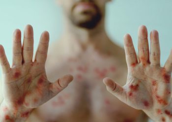 Porto Velho confirma 1 caso de Mpox e investiga outros dois, informa Sesau