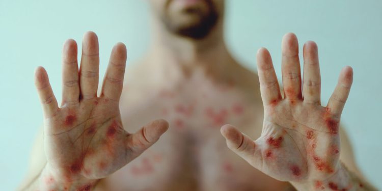 Porto Velho confirma 1 caso de Mpox e investiga outros dois, informa Sesau